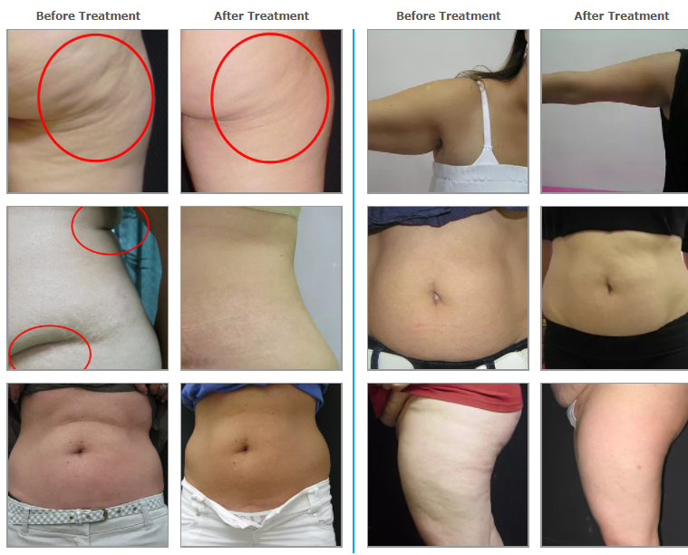 https://www.medispec.com/wp-content/uploads/2022/02/before-and-after-cellulite-removal-2.png